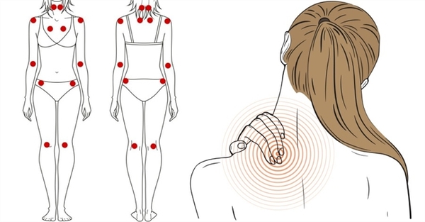 Hội chứng đau xơ cơ cũng gây nên tình trạng đau lưng